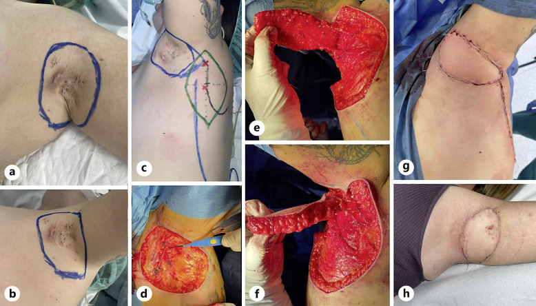 Parascapular Flap for Severe Hidradenitis Suppurativa.