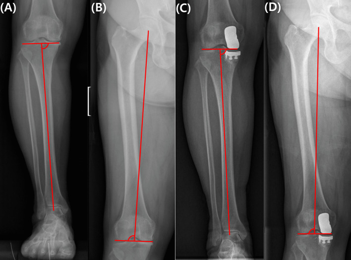 Preserving coronal knee alignment of the knee (CPAK) in unicompartmental knee arthroplasty correlates with superior patient-reported outcomes.
