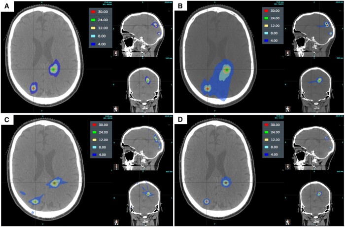 A multi-centre stereotactic radiosurgery planning study of multiple brain metastases using isocentric linear accelerators with 5 and 2.5 mm width multi-leaf collimators, CyberKnife and Gamma Knife.