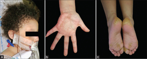 Woolly Hair: Essential Clue in Carvajal Syndrome.