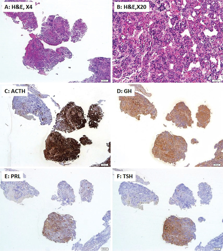 Cushing Disease in a Patient with Double Pituitary Adenomas Complicated with Diabetes Insipidus: A Case Report.