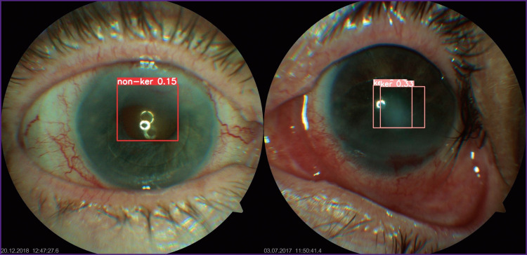 Application of Deep Learning Algorithms Based on the Multilayer Y0L0v8 Neural Network to Identify Fungal Keratitis.