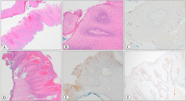 A Low-Risk HPV-Associated Well-Differentiated Squamous Cell Carcinoma of the Cervix with Low-Grade Squamous Intraepithelial Lesion Morphology: Clinical and Pathologic Diagnostic Difficulties and Review of the Literature.