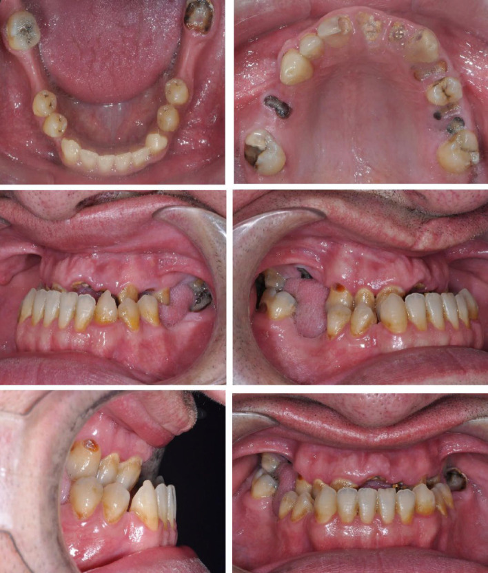 Intermaxillary Fixation Screws (IMF) & Surgery First Approach: A Novel Combination and Case Report.