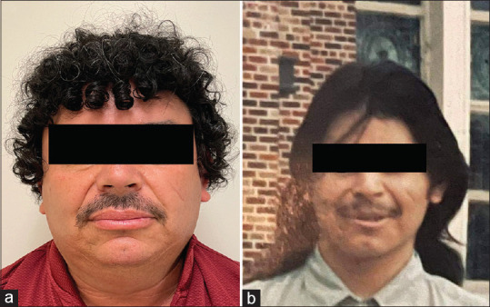COVID Curls: A Striking Change in Hair Texture Following COVID-19 Infection.