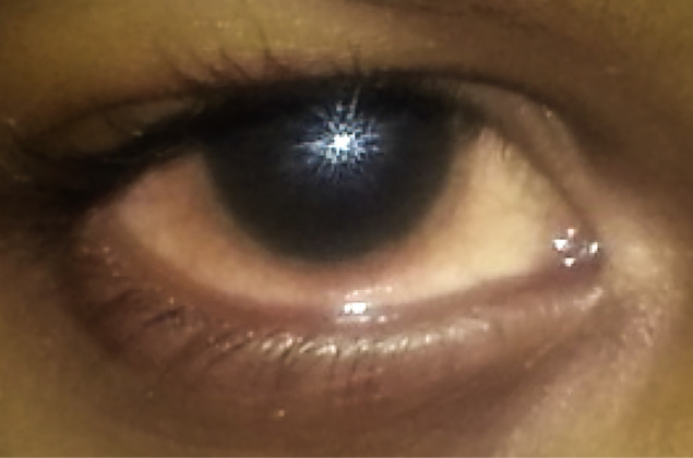 Managing ocular allergy.