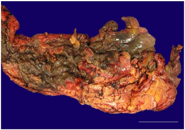 Necrotizing fasciitis and fatal septic shock associated with <i>Streptococcus constellatus</i>.