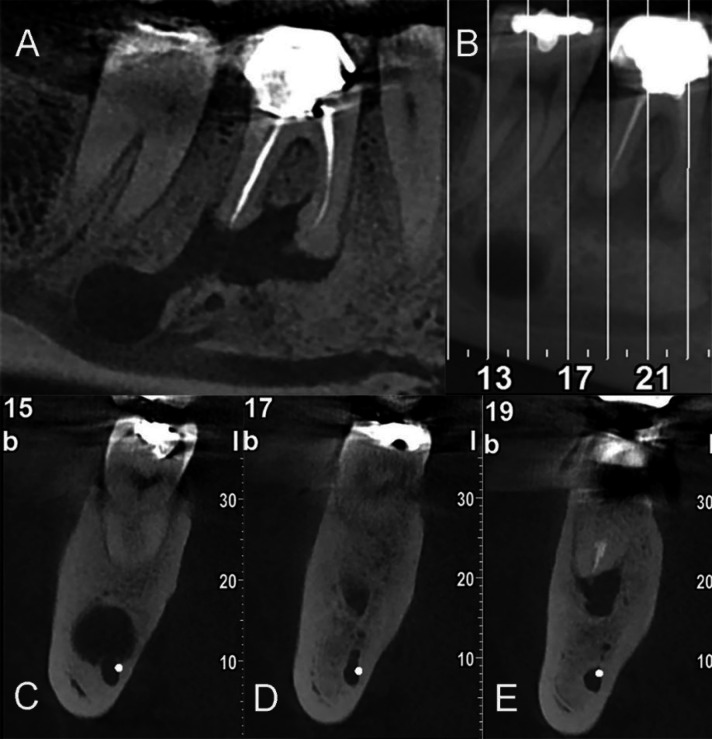 Successful Management of a Rare Distant Endodontic Lesion: A Case Report.