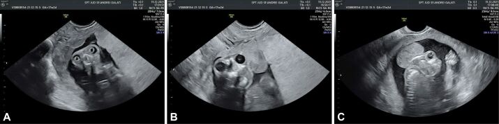 Fetal acrania diagnosed at 17 weeks of gestation by 2D∕3D ultrasound: a case report and literature review.