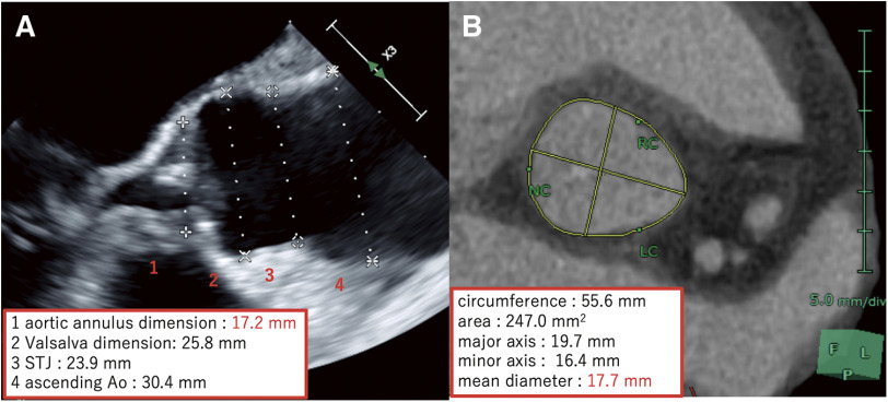 Aortic Annular Enlargement with Modified Y-Incision Technique Devised from Preoperative Three-Dimensional Computed Tomography.