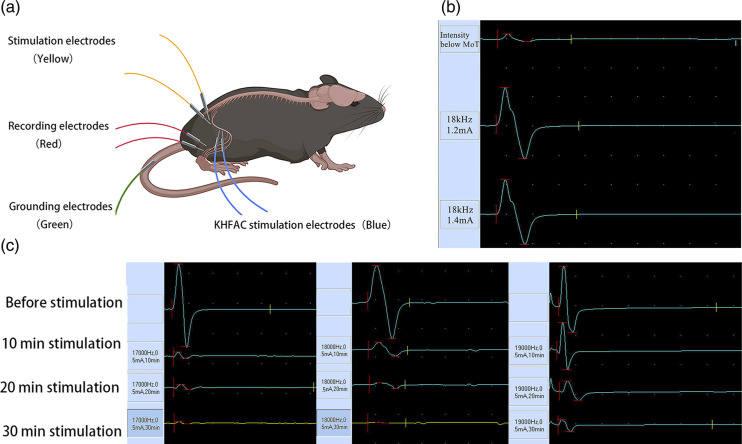 Kilohertz high-frequency electrical stimulation ameliorate hyperalgesia by modulating transient receptor potential vanilloid-1 and N-methyl-D-aspartate receptor-2B signaling pathways in chronic constriction injury of sciatic nerve mice.