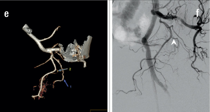 Assessement of Radiological Anatomy of Prostatic Artery on 3D DECT in Symptomatic Benign Prostatic Hypertrophy.