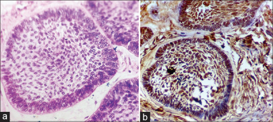 Immunohistochemical evaluation of yes-associated protein molecule in the odontogenic epithelium of different histopathological variants of ameloblastoma and unicystic ameloblastoma.