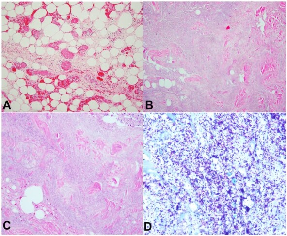 Necrotizing fasciitis and fatal septic shock associated with <i>Streptococcus constellatus</i>.