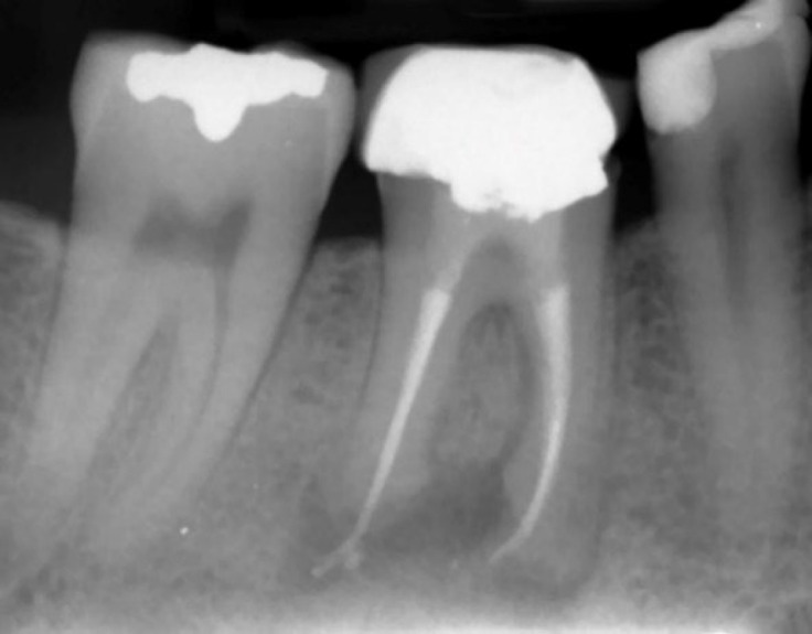 Successful Management of a Rare Distant Endodontic Lesion: A Case Report.
