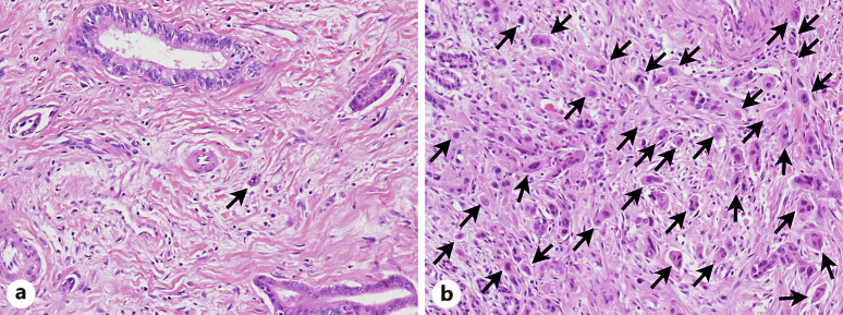 Prognostic Significance of Intratumoral and Peritumoral Budding in Distal Extrahepatic Bile Duct Carcinoma.