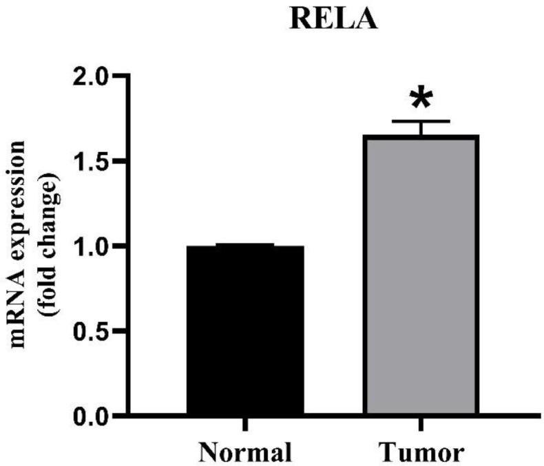LINC01366 and LINC01433 in Glioblastoma Multiforme: A Potential Role at the Intersection of Inflammation and Angiogenesis.