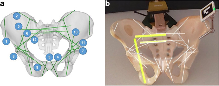 Augmented reality-based surgical navigation of pelvic screw placement: an ex-vivo experimental feasibility study.