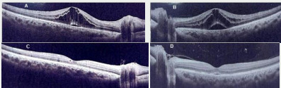 New onset of uveitis during infliximab treatment: A case report.