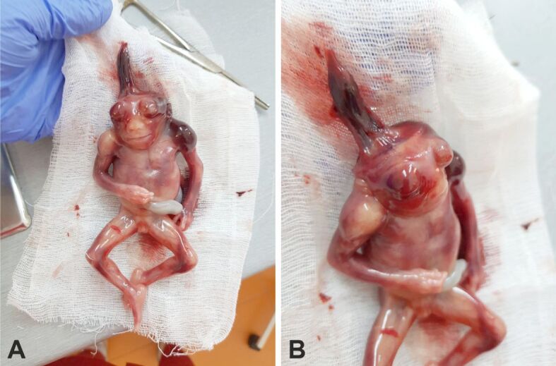 Fetal acrania diagnosed at 17 weeks of gestation by 2D∕3D ultrasound: a case report and literature review.