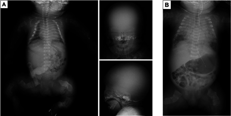 Fatality owing to pulmonary hemorrhage following pamidronate disodium administration in a neonate with osteogenesis imperfecta type 2: A case report.