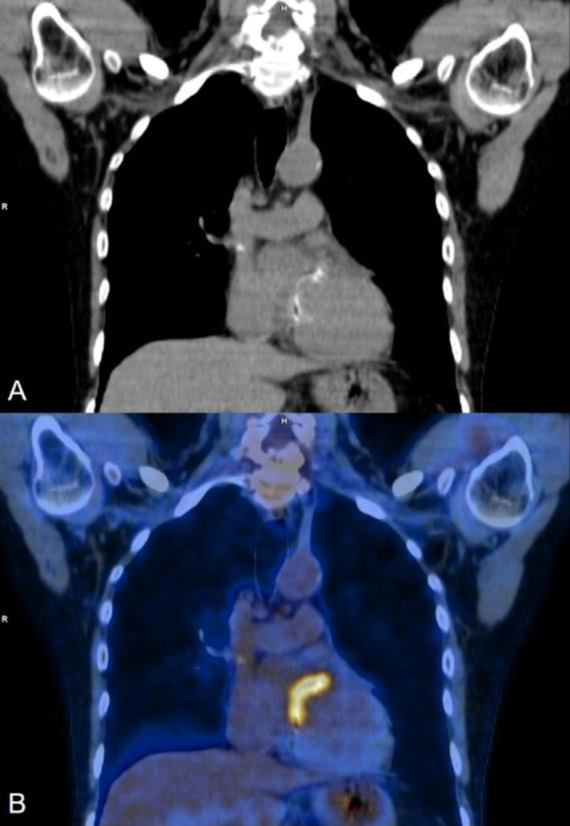 <sup>18</sup>F-FDG PET CT in cardiac device infections - A Case series.