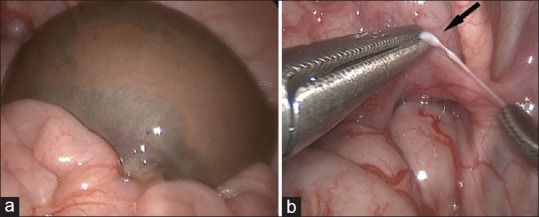 Laparoscopic Management of Auto-Amputated Ovarian Cyst in an Infant.