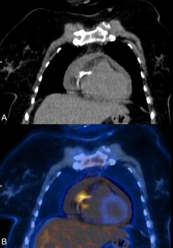 <sup>18</sup>F-FDG PET CT in cardiac device infections - A Case series.
