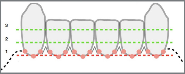 Periodontal indexes of two types of 3 x 3 retainers: 0.032-in SS V-loop versus 0.0215-in SS coaxial - a randomized crossover trial.