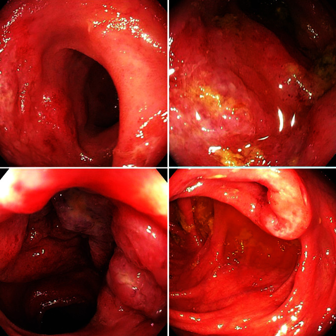 Colonoscopy Findings of Uncomplicated Enteric Fever Mimicking Koch's Disease.