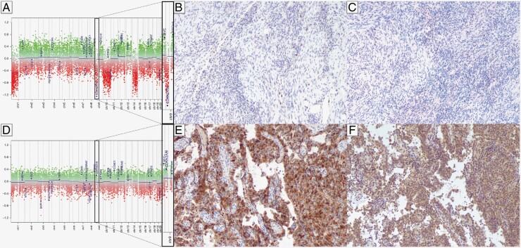 Molecular prognostication in grade 3 meningiomas and p16/MTAP immunohistochemistry for predicting <i>CDKN2A/B</i> status.