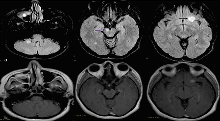 New diagnosis of multiple sclerosis in the setting of recent Sinopharm COVID-19 vaccine (BBIBP-CorV) exposure: A series of clinical cases and updated review of the literature.