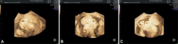 Fetal acrania diagnosed at 17 weeks of gestation by 2D∕3D ultrasound: a case report and literature review.