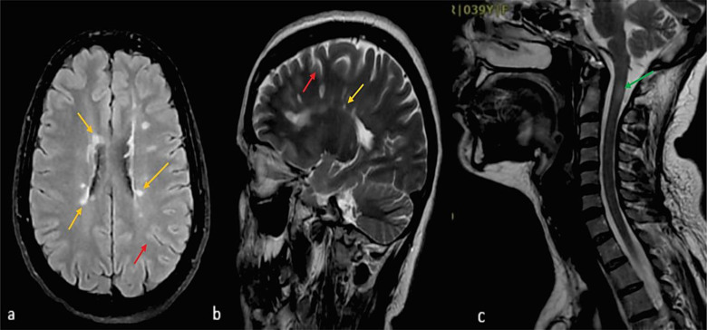 New diagnosis of multiple sclerosis in the setting of recent Sinopharm COVID-19 vaccine (BBIBP-CorV) exposure: A series of clinical cases and updated review of the literature.