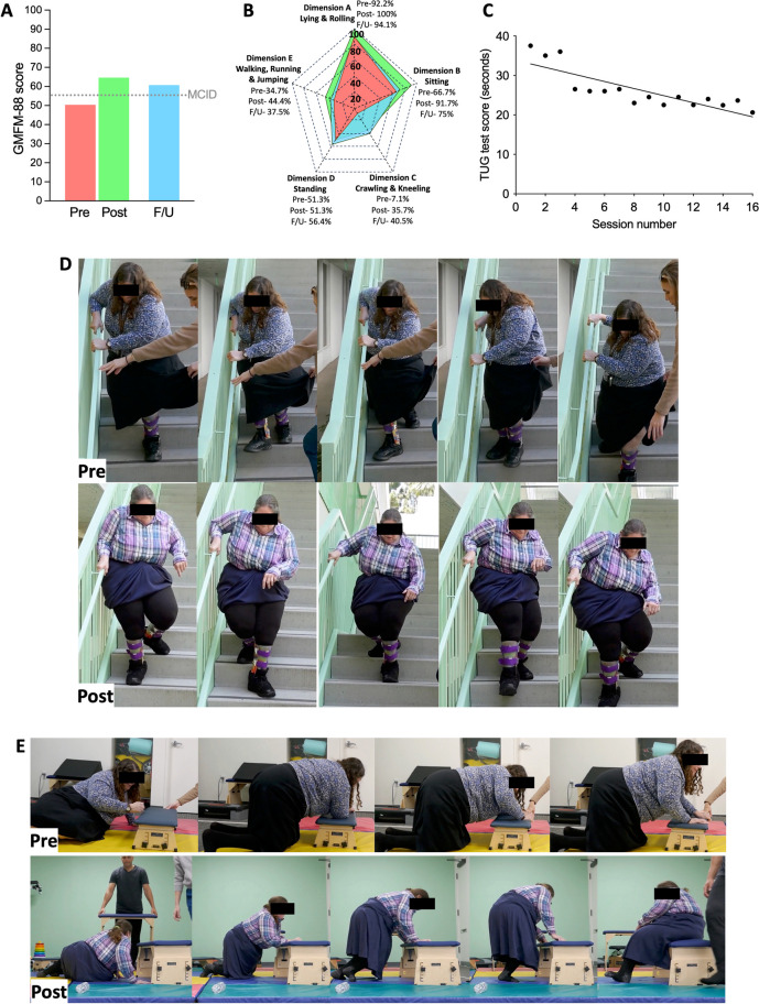 Beyond pediatrics: noninvasive spinal neuromodulation improves motor function in an adult with cerebral palsy.