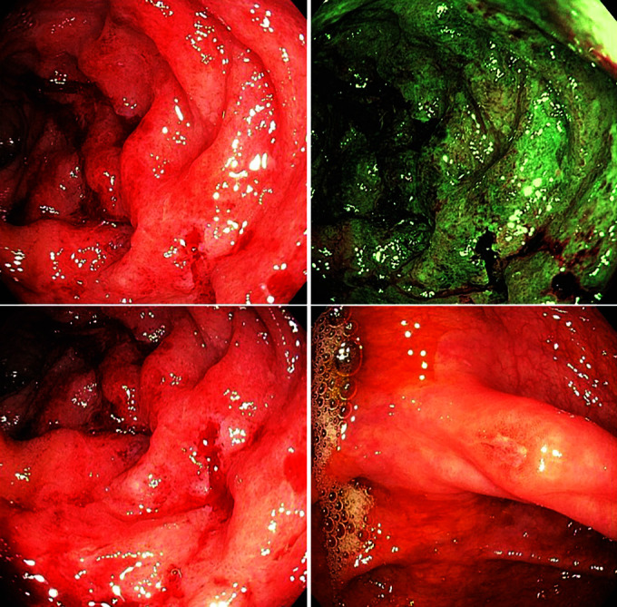 Colonoscopy Findings of Uncomplicated Enteric Fever Mimicking Koch's Disease.