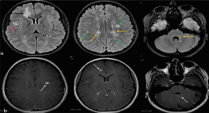 New diagnosis of multiple sclerosis in the setting of recent Sinopharm COVID-19 vaccine (BBIBP-CorV) exposure: A series of clinical cases and updated review of the literature.