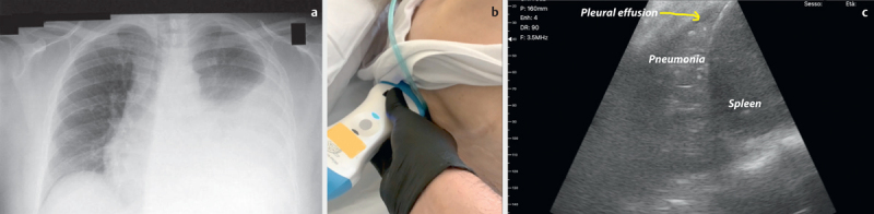 Bedside Clinical Hand-held Ultrasound in an Internal Medicine Department: The "Bed Med-Us" Experience of Codogno and its Clinical Utility in the Management of Diagnosis and Therapy in 1007 Patients.