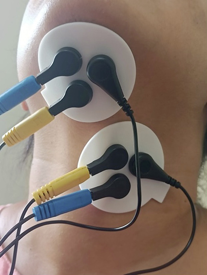 Comparison of Submental Surface Electromyography during Dry Swallow between Irradiated Head and Neck Cancer Survivors and Normal Individuals.