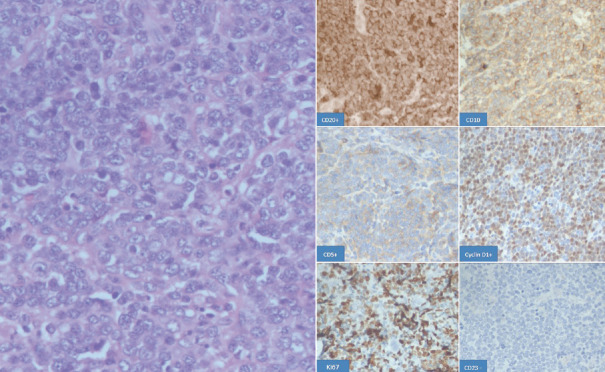 Blastoid Variant of Mantle Cell Lymphoma with Extranodal Presentation and Aberrant CD10 Expression.