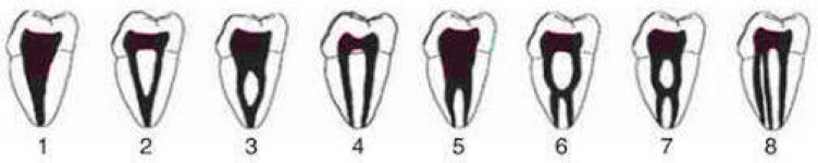 Evaluation of Root Canal Morphology of Mandibular Premolars Using Cone-beam Computed Tomography in Golestan Province, North of Iran.