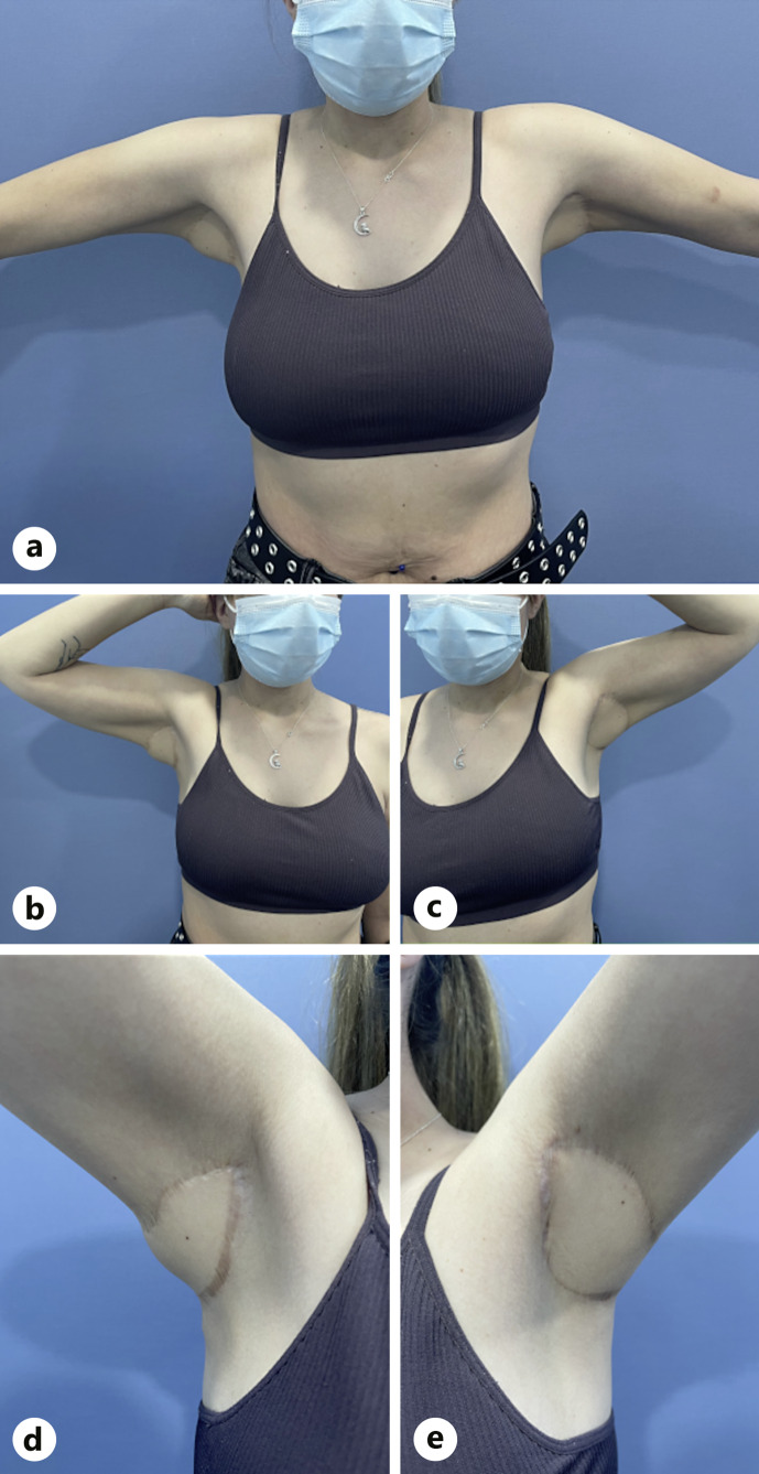 Parascapular Flap for Severe Hidradenitis Suppurativa.