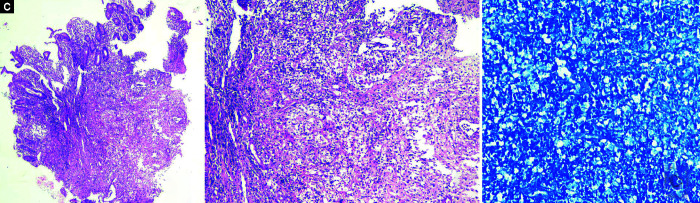Colonoscopy Findings of Uncomplicated Enteric Fever Mimicking Koch's Disease.