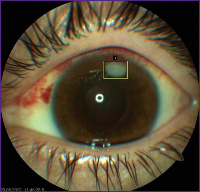Application of Deep Learning Algorithms Based on the Multilayer Y0L0v8 Neural Network to Identify Fungal Keratitis.