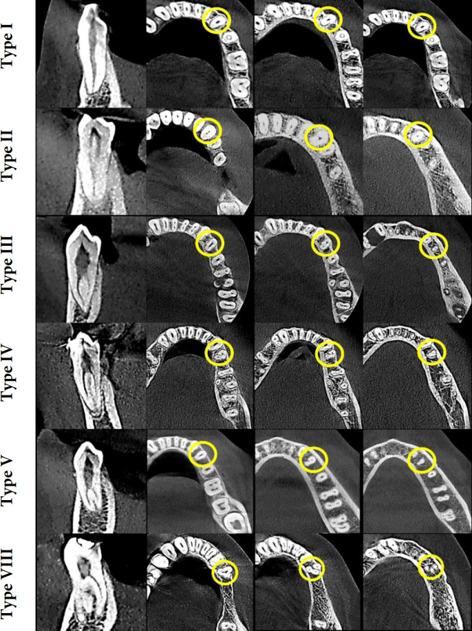 Evaluation of Root Canal Morphology of Mandibular Premolars Using Cone-beam Computed Tomography in Golestan Province, North of Iran.