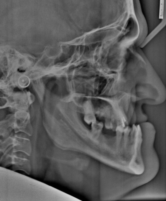 Intermaxillary Fixation Screws (IMF) & Surgery First Approach: A Novel Combination and Case Report.