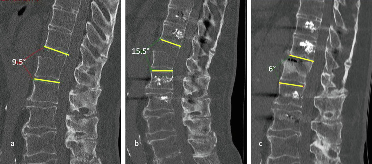 Isolated posterior stabilization in type B and C thoracolumbar fractures associated with ankylosing spine disorders: A single center experience with clinical and radiological outcomes.