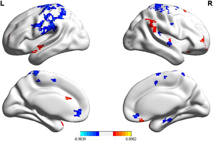 Effects of Transcranial Direct Current Stimulation on Graph Naming Function and Brain Connectivity in Postinfarction Aphasia Patients: An fMRI Study.