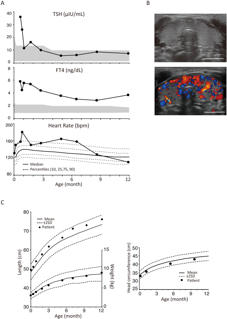 Concurrent <i>THRB</i> and <i>DUOX2</i> variants in a patient detected via newborn screening for congenital hypothyroidism: a case of resistance to thyroid hormone.