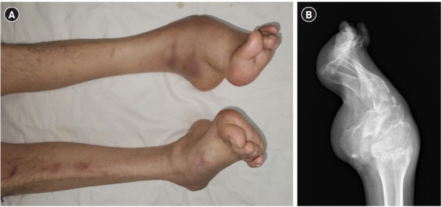 ﻿Neuromuscular monitoring of a patient with Charcot-Marie-Tooth disease; which monitoring technique is adequate? - A case report and literature review.